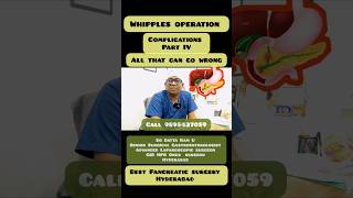 Whipples operation part IV complications best Pancreatic surgeon [upl. by Sirtemed783]