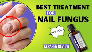 Kerafen Review  Best Treatment For Nail Fungus  MustWatch [upl. by Binny]