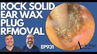 ROCK SOLID EAR WAX PLUG REMOVAL  EP931 [upl. by Engvall]