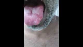 Geographic tongue [upl. by Haiasi]