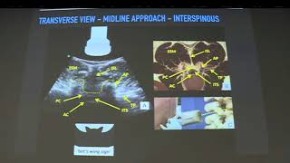 Lecture  Spinal Neuraxial  Obstetric Ultrasound  Dr Baskar Manickam [upl. by Pontone]