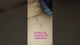 Acupuncture treatment for cervical spine acupuncturists painrelief [upl. by Akcirre351]