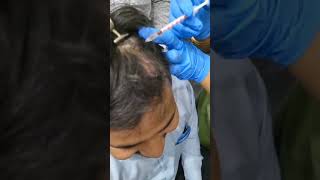 Hair transplant after PRP therapy2024 youtuber hairtreatment song skincare prp explore skin [upl. by Rakia590]