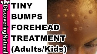 HOW TO GET RID OF TINY BUMPS ON FOREHEAD in 10 DAYS  Acne Pimple Rashes I KIDS and ADULTS [upl. by Anay]