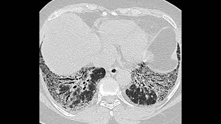 Fibrose pulmonar [upl. by Neyr]