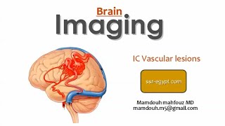 Imaging of intracerebral vascular lesions DRE Prof Mamdouh Mahfouz [upl. by Ym]