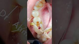 Single Visit Endodontic Treatment الكربولة endodontics dental [upl. by Aihsei]