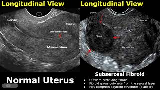 Uterus Ultrasound Normal Vs Subserosal Fibroid Images  Uterine Leiomyomas Cases  Pelvic USG Cases [upl. by Nazarius]