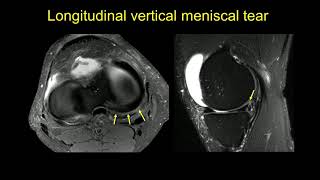 Imaging of the menisci [upl. by Ahsonek]