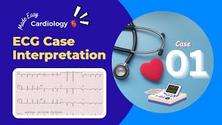 Abnormality in ECG Graph  Discussion about ECG Cases  ECG Cases for Students [upl. by Beltran98]