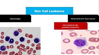 aplastic anemia part 2 diagnosis differential diagnosis treatment [upl. by Ettelimay]