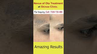 Nevus of Ota Treatment at Skinaa clinic short [upl. by Brandise]