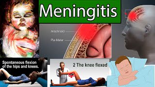 Meningitis in Children  Most Deadly infection for Children [upl. by Mellisa]