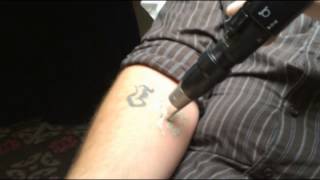 PicoSure Laser Tattoo Removal Demonstration in Toronto  SpaMedicaTV [upl. by Ajnos]