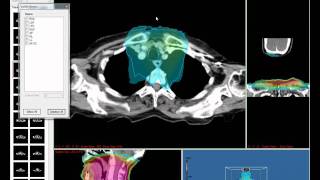 Fratoria Dicom RT Viewer  Part 1 [upl. by Tteragram]