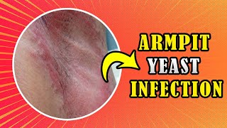 How to treat Armpit yeast infection Candida at home [upl. by Anderegg]