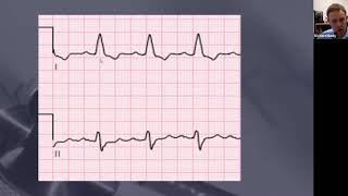 ECG in a Minute LBBB and LAD [upl. by Seta351]