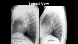 Chest Xray Cases 2 [upl. by Hsirrehc]