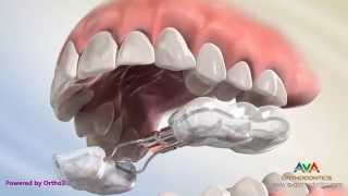 Orthodontic Expander or Spacer  Bonded RPE Appliance [upl. by Antonin]