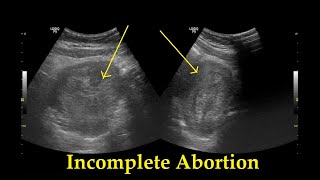 Incomplete Abortion  Ultrasound  Case 25 [upl. by Thorlay]