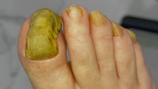 Huge ingrown toenail fungus treatment  Best video good healthy 01 [upl. by Pfeffer]