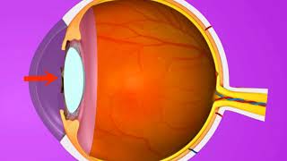 Vision problem Hypermetropia and its correction 3D animation – in English [upl. by Rihat237]