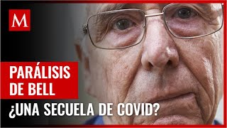 ¿Qué es la parálisis de Bell la complicación que puede dar después de covid [upl. by Rush]