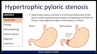 Hypertrophic Pyloric stenosis [upl. by Manley]