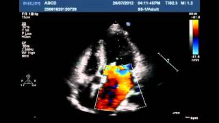 Cardiac affection due to rheumatic fever [upl. by Emerson]