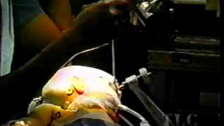 Hemispherectomy  Understanding the Amazing Brain  The Learning Channel  1999 [upl. by Aneelas]