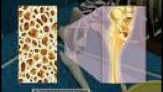 Osteoporosis3D Medical Animation [upl. by Inohs]