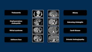 Biliary Emergencies  Interesting Radiology Cases [upl. by Nivrem671]