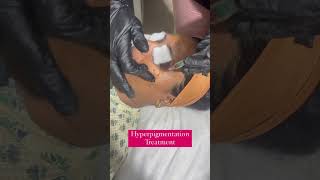 Hyperpigmentation Treatment viralshorts trending shortvideos [upl. by Enelehcim]