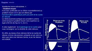 rétrécissement aortique [upl. by Anear]