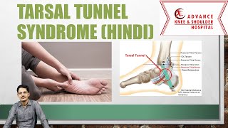 Tarsal Tunnel syndrome Hindi [upl. by Ballinger124]