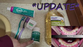 Updated How to Get Rid of Tartar amp Plaque  Aerica Lee [upl. by Valonia]