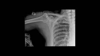 Shoulder XRay in Motion [upl. by Munro]