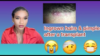 Ingrown Hairs amp Pimples After a Hair Transplant My Tips to help [upl. by Raoul]