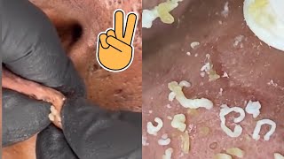 Big Cystic Acne Blackheads Extraction Blackheads amp Milia Whiteheads Removal Pimple Popping [upl. by Ateekahs]