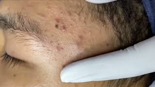 Blackheads amp Whiteheads Removal New On ForeHead 2024 Acne Treatment With Nhat Bang [upl. by Miguelita477]