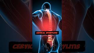 Cervical Spondylitis  Spondin Drops Back pain treatment [upl. by Aitan]