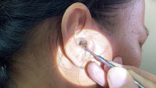 Massive Hard Dry Earwax Removed from Womans Ear [upl. by Dnomal694]