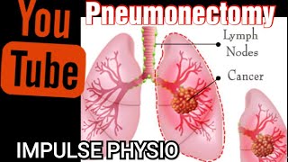 Pneumonectomy Impulse physio [upl. by Aronaele]