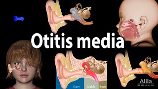 Otitis Media Anatomy Pathophysiology Risk Factors Types of OM Symptoms and Treatment Animation [upl. by Henke]