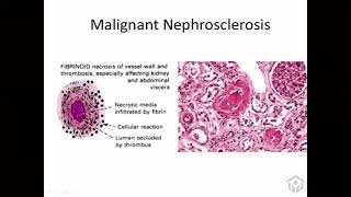 Vascular diseases of kidney [upl. by Tien359]