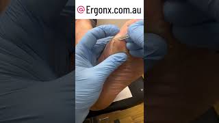 Thick callus hard skin removal by podiatrist with scalpel [upl. by Pigeon648]