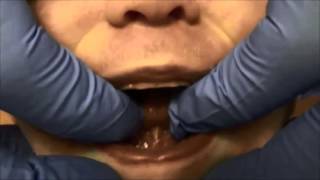 Finding a posterior tongue tie [upl. by Attesoj]