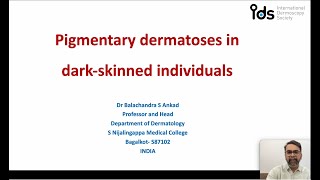 Pigmentary Dermatosis in dark skinned individuals  Dr Balachandra Ankad [upl. by Debbi]