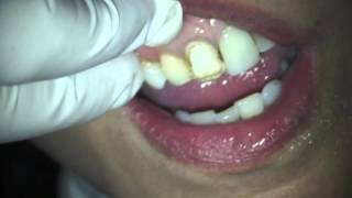 Dr Harvey Shiffman Fotona Lightwalker Dental Laser Veneer Removal [upl. by Felton]