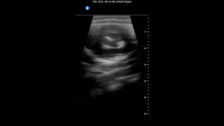 Intermittent Fussiness for 3 days in 7 month old Boy [upl. by Thorpe]